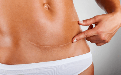 chirurgie des cicatrices