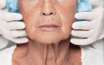 Lifting cervico facial