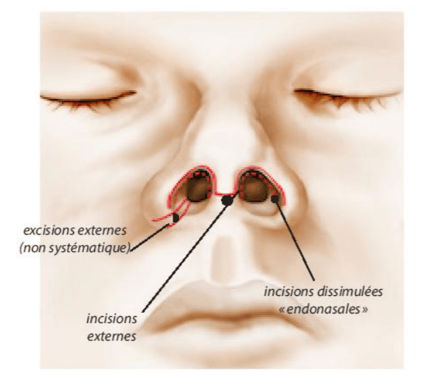 Post opération rhinoplastie