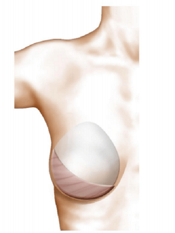 Post opératoire lambeau grand dorsal reconstruction mammaire