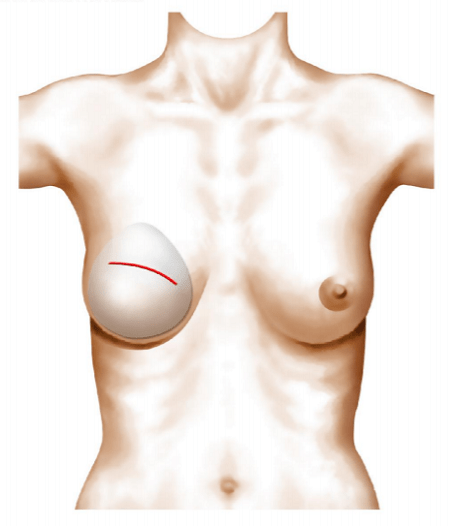 Post opératoire prothèse reconstruction du sein