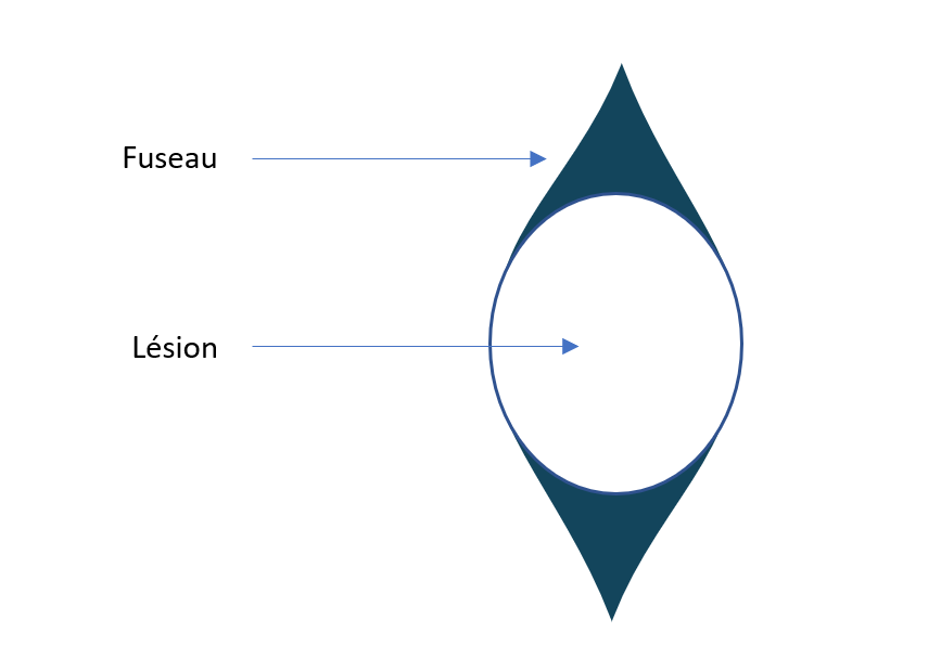 Intervention sur lésions bénignes