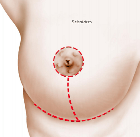 Intervention réduction mammaire