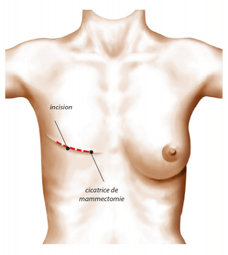 Intervention prothèse reconstruction du sein