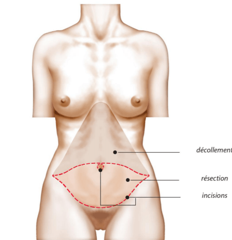 intervention abdominoplastie