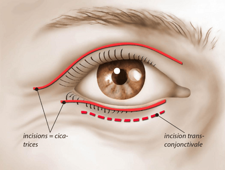 Intervation Blépharoplastie