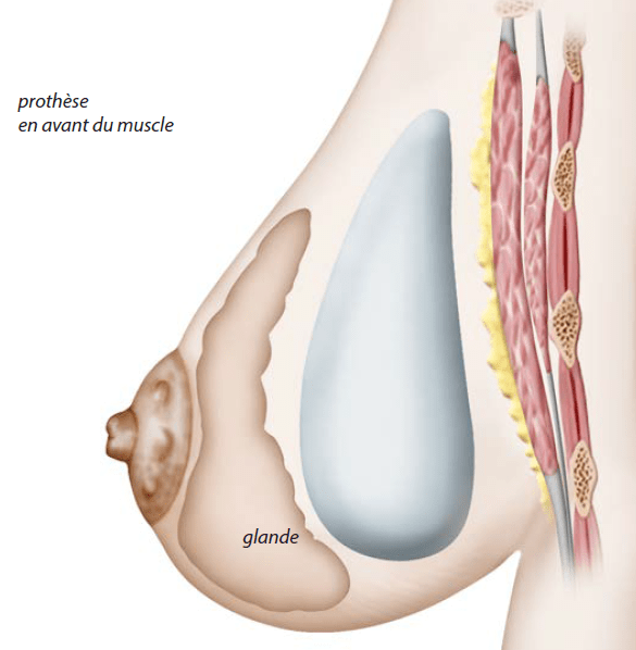 Intervention prothèse mammaire