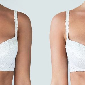 comparaison avant et après chirurgie du sein asymétrie